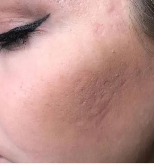 Collagen therapy