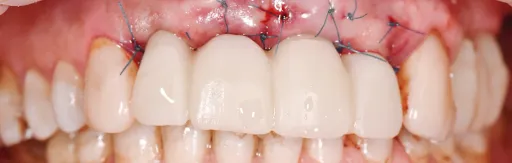Simultaneous implantation