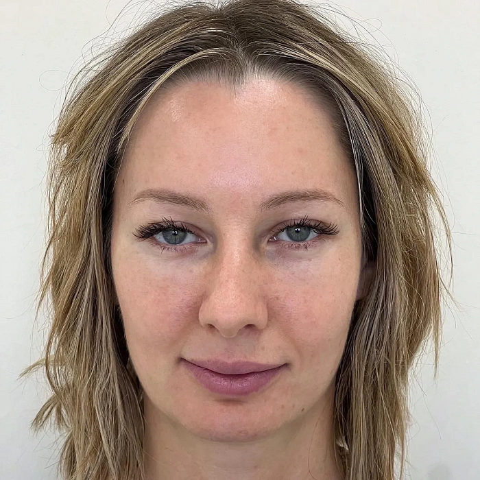 Lipofilling